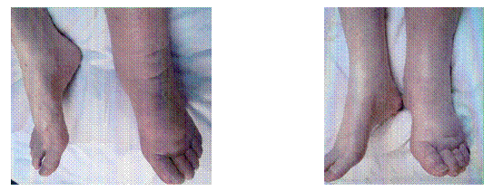 Lower Extremity Lymphedema 2